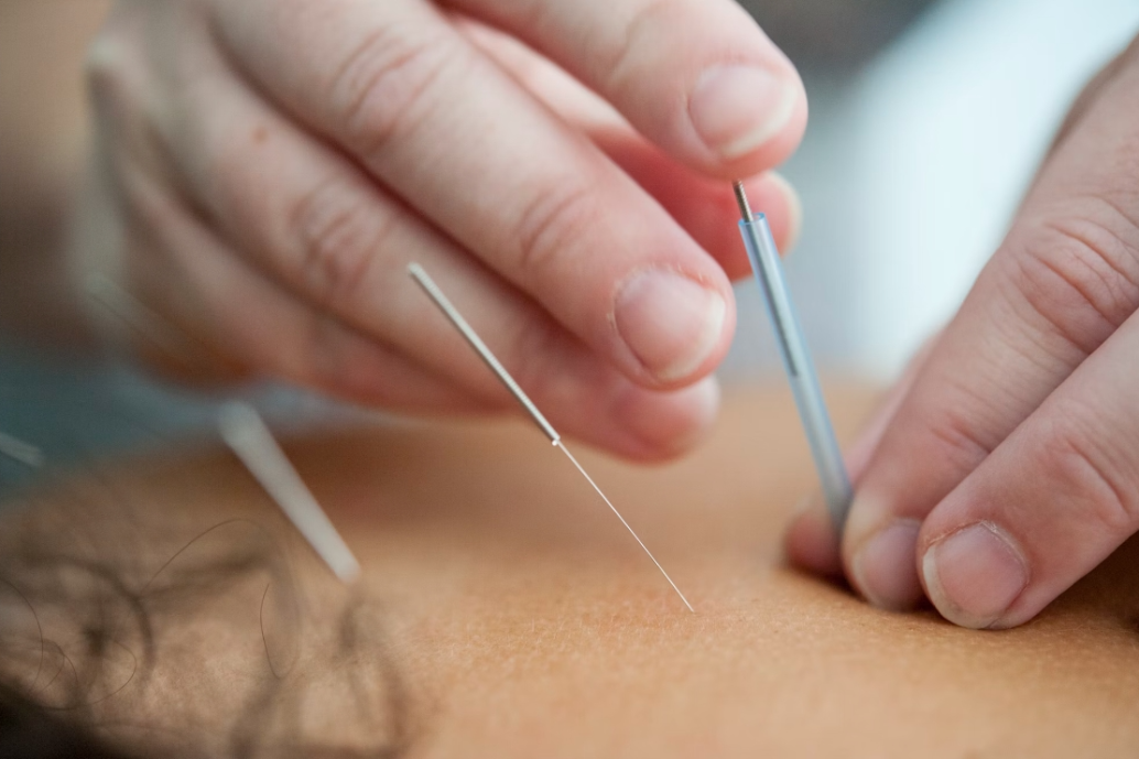 Acupuncture